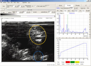 B-Scan of the first tumour