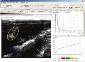 B-Bild-Scan des zweiten Tumors