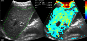 B-Modus-Ultraschallbild und großes B-Modus-Elastogramms auf dem THED-Computerbildschirm