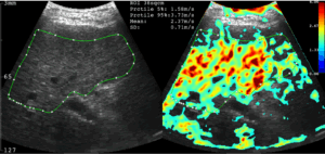 B-Modus-Ultraschallbild und großes B-Modus-Elastogramms auf dem THED-Computerbildschirm