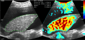 B-Modus-Ultraschallbild und großes B-Modus-Elastogramms auf dem THED-Computerbildschirm
